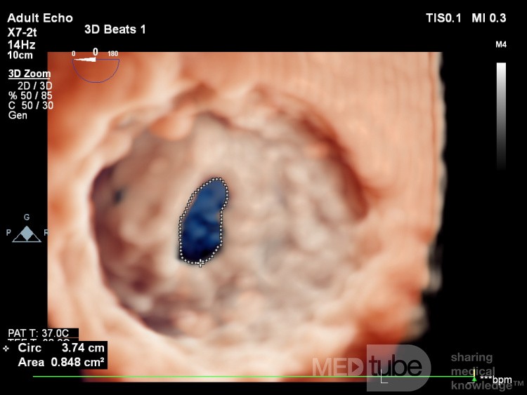 Mitral Stenosis TEE 3D, Trevue