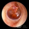 Otitic Barotrauma Right Ear
