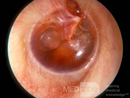 Otitic Barotrauma Right Ear