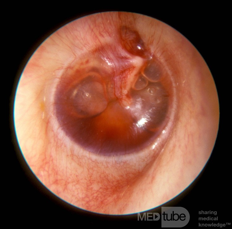 Otitic Barotrauma Right Ear