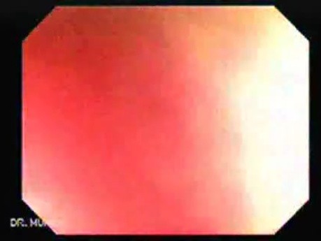 Colonoscopic Polypectomy (8 of 29)