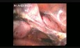 Fibroid Uterus TLH BSO by Dr.Avijit Basak