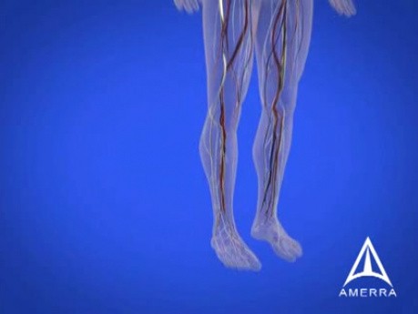 Diabetes Education - 3D Medical Animation 