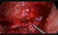 Live Surgery from Manila: Pulmonary Sequestration with 4 Abnormal Branches from Aorta