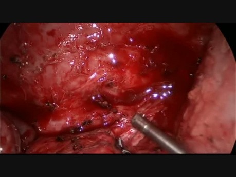 Live Surgery from Manila: Pulmonary Sequestration with 4 Abnormal Branches from Aorta