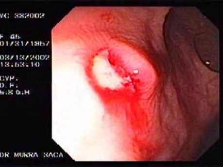 Rectal Amebiasis (1 of 2)