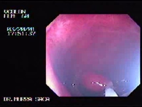 Endoscopic Polypectomy (2 of 2)