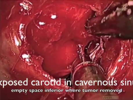 Exposed Carotid Artery during Pituitary Surgery