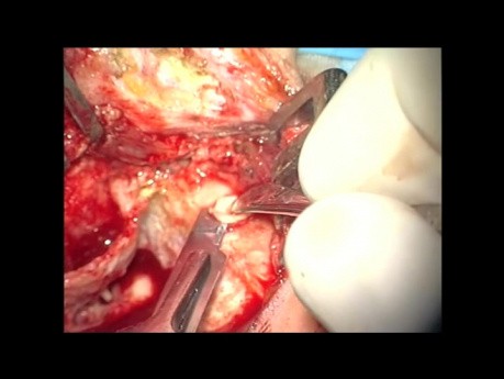 Second – Look Tympanoplasty With MFA Ossiculoplasty 