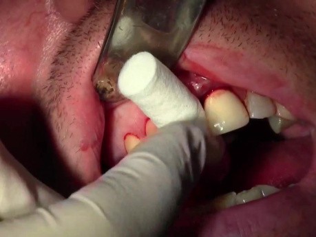 Extraction #8 With Socket Grafting II