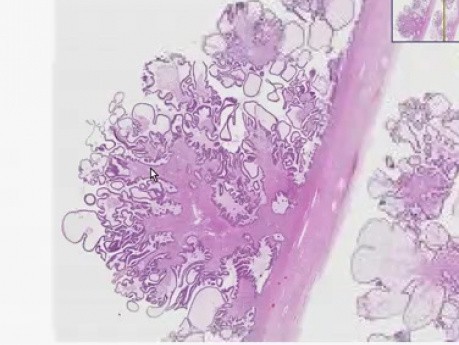 Serous cystadenoma - Histopathology of ovary