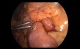 Duodeno-Jejunal Anastomosis for Superior Mesenteric Artery Syndrome 