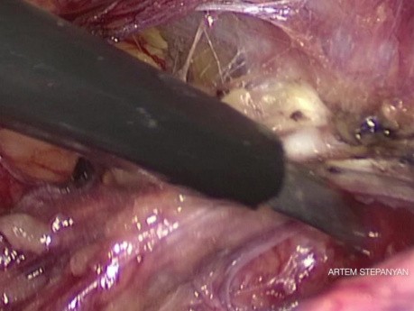 The Laparoscopic Extended Pelvic Lymphadenectomy