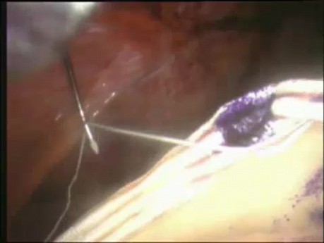 Laparoscopic repair of incisional hernia