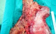 Total Laparoscopic Gastrectomy