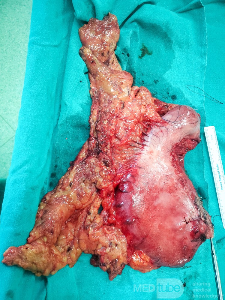 Total Laparoscopic Gastrectomy