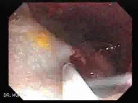 Huge Mass Of The Descending Colon (5 of 25)