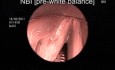 Assessment of Dysplatic Laryngeal Lesions