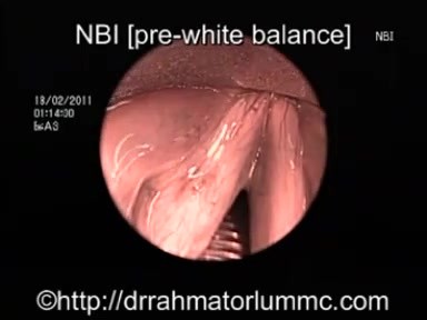 Assessment of Dysplatic Laryngeal Lesions