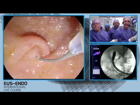 ERCP with Minor Papilla Cannulation
