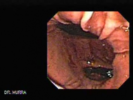 The Stomach - Video Endoscopic Sequence (2 of 6)