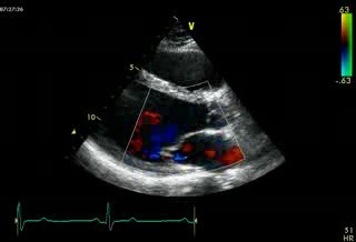 Echocardiography - Parasternal View - Normal Study