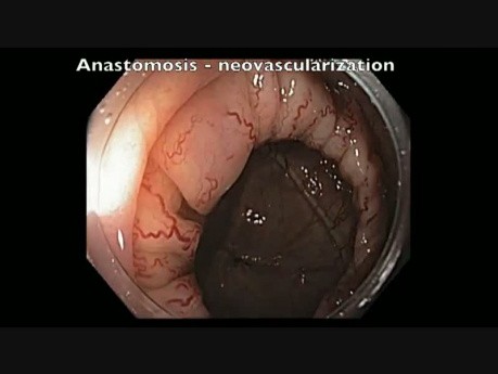 Colon Anastomosis Neovascularization