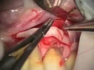 CGingival Grafting Indidations