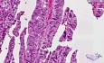 Extrahepatic bile ducts, common bile duct - Histopathology 
