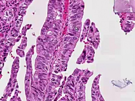 Extrahepatic bile ducts, common bile duct - Histopathology 