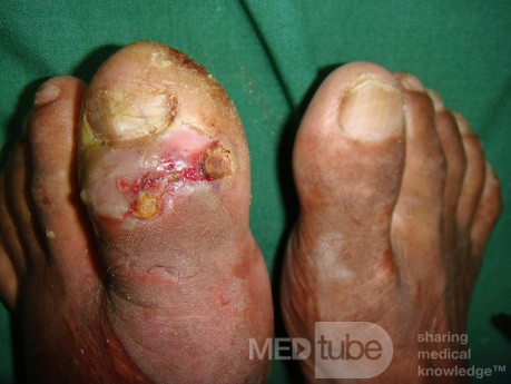 Left Hallux Osteomyelitis 