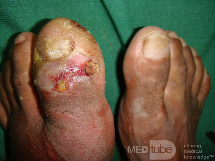 Left Hallux Osteomyelitis 
