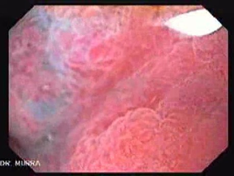 Gastric Polyp (5 of 7)