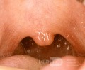 Submucosal Bifid Uvula