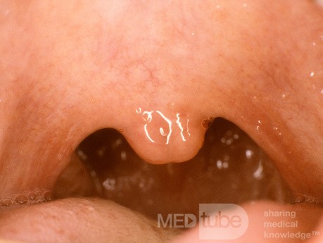 Submucosal Bifid Uvula