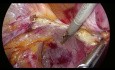 Laparoscopic Uterine Artery at Origin