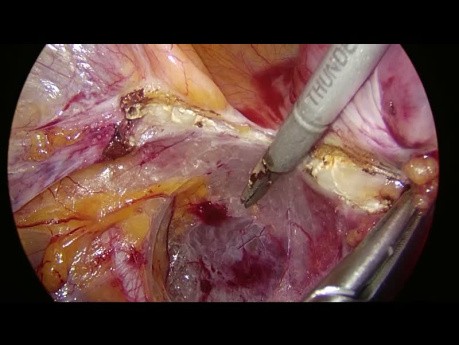 Laparoscopic Uterine Artery at Origin