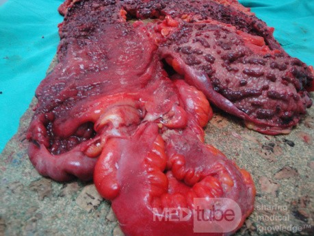 Multiple Rectal Ulcers (88 of 110)