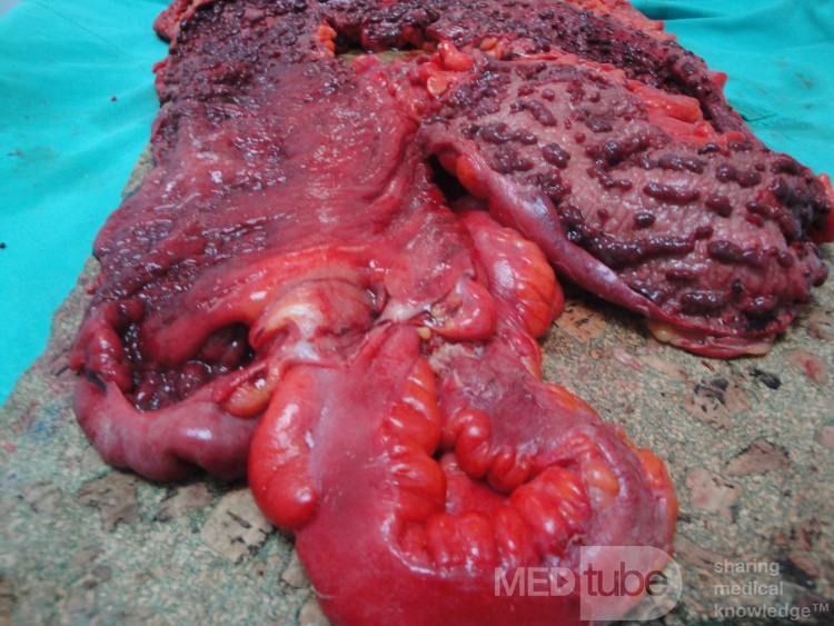 Multiple Rectal Ulcers (88 of 110)