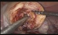 Adenoma Excision