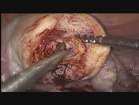 Adenoma Excision