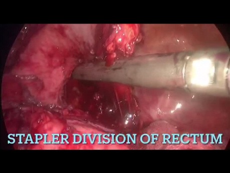 Laparoscopic Management of Post Anastomotic Colorectal Structure