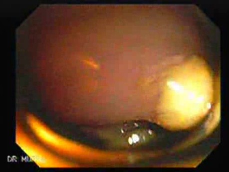 Pseudomembranous Colitis (5 of 11)