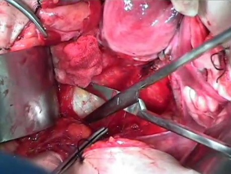 Anatomy of the Pelvis - Three Anterior Avascular Spaces