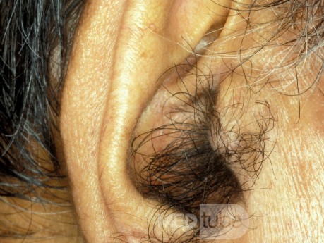 Hairy Tragus