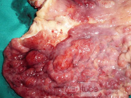 Endoscopy of Scirrhous Gastric Carcinoma involving the entire Fundus, Body and the Antrum (30 of 47)