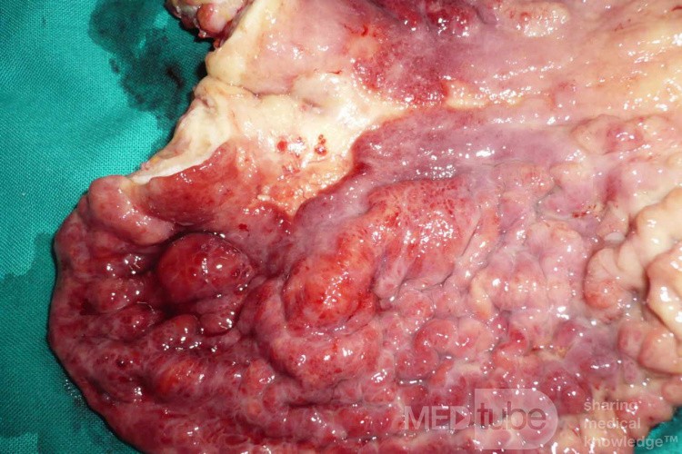 Endoscopy of Scirrhous Gastric Carcinoma involving the entire Fundus, Body and the Antrum (30 of 47)