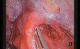Single-port Thoracoscopic Resection of Complex Mediastinal Cystic Mass