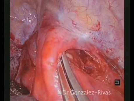 Single-port Thoracoscopic Resection of Complex Mediastinal Cystic Mass