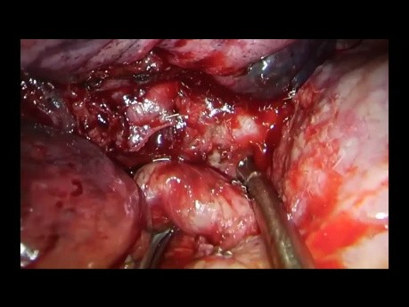 Huge Lung Cancer Right Upper Sleeve Lobectomy Operated by Uniportal VATS